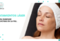 Laser treatments to remove skin spots